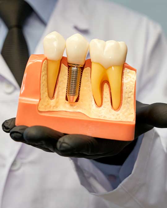 benefícios-do-implante-dentério-para-a-estrutura-óssea