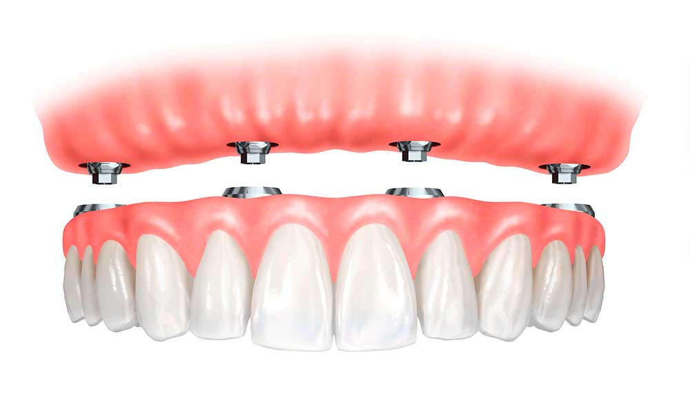 dentista implante protese com protocolo em barroso e dores de campos