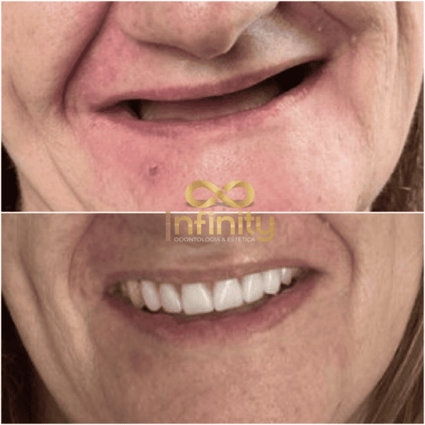 resultados tratamentos com impalntes dentários (1)