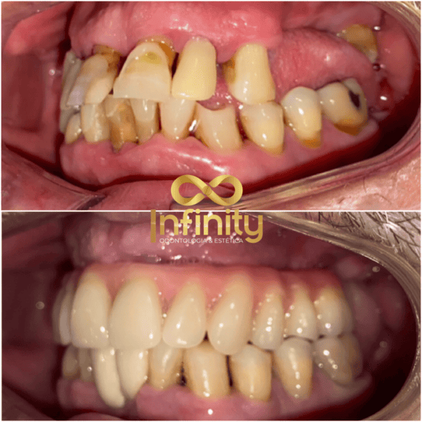 resultados tratamentos com impalntes dentários (10)