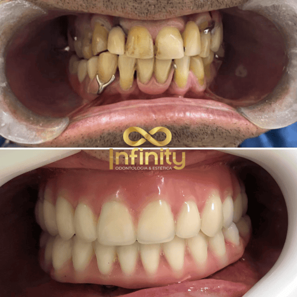 resultados tratamentos com impalntes dentários (11)