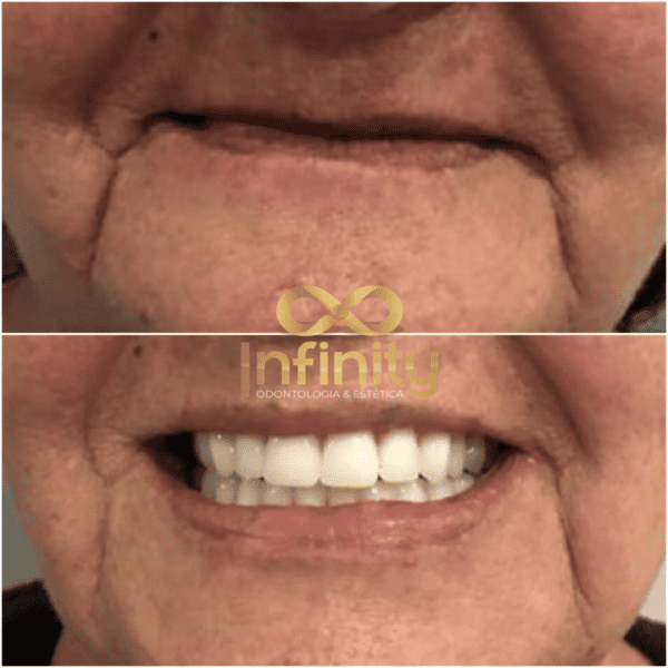resultados tratamentos com impalntes dentários (14)