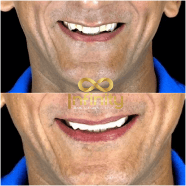 resultados tratamentos com impalntes dentários (15)