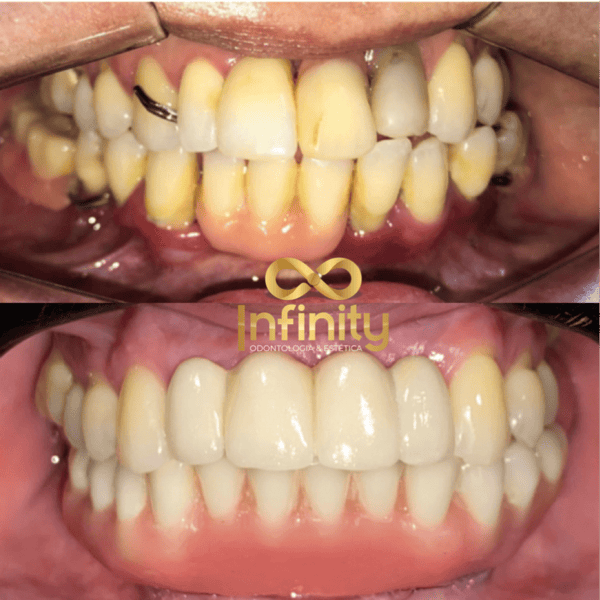 resultados tratamentos com impalntes dentários (17)
