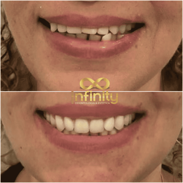 resultados tratamentos com impalntes dentários (2)