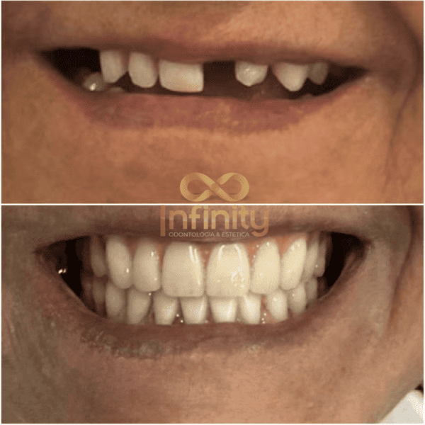 resultados tratamentos com impalntes dentários (20)