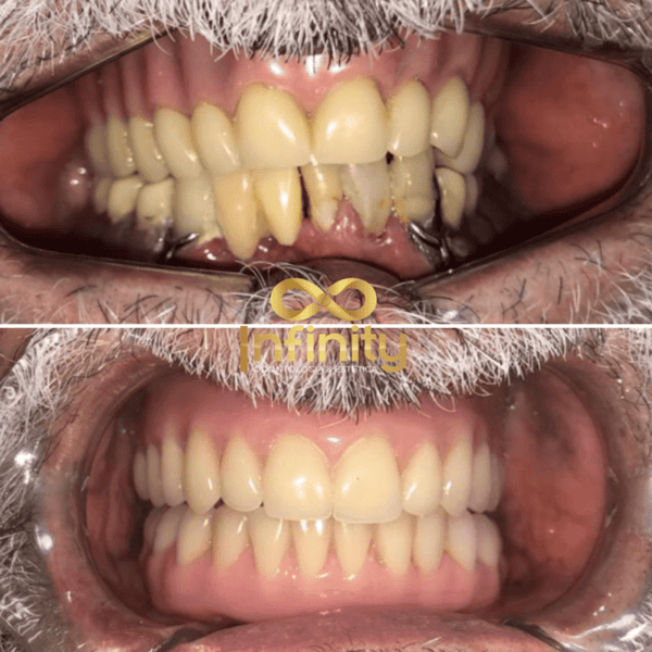 resultados tratamentos com impalntes dentários (21)