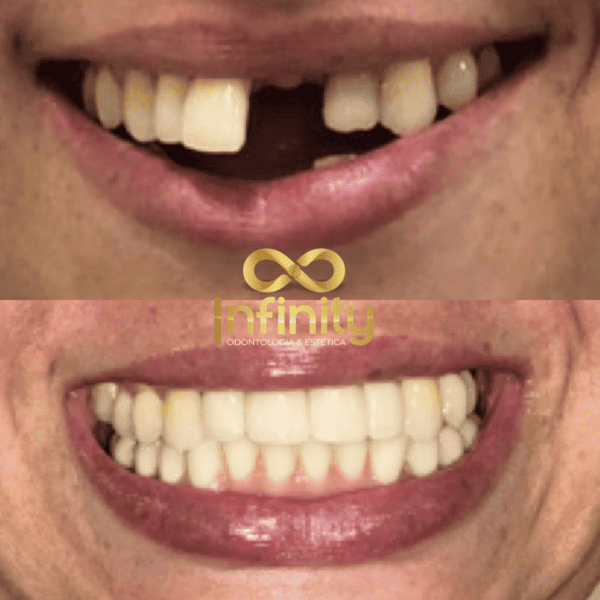 resultados tratamentos com impalntes dentários (23)