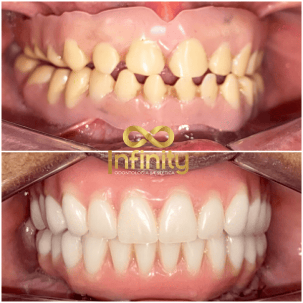 resultados tratamentos com impalntes dentários (3)