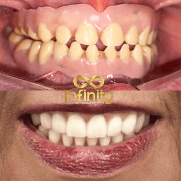 resultados tratamentos com impalntes dentários (4)