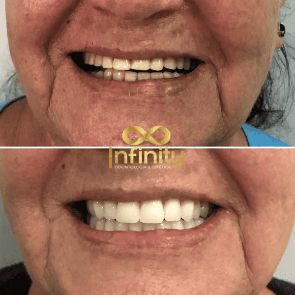 resultados tratamentos com impalntes dentários (5)
