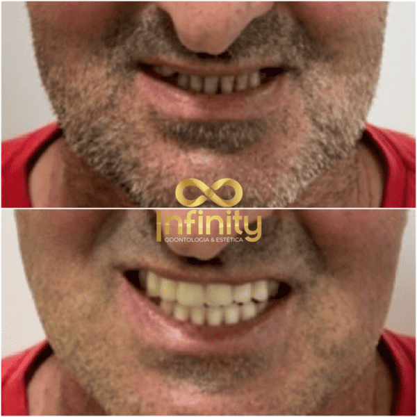 resultados tratamentos com impalntes dentários (6)