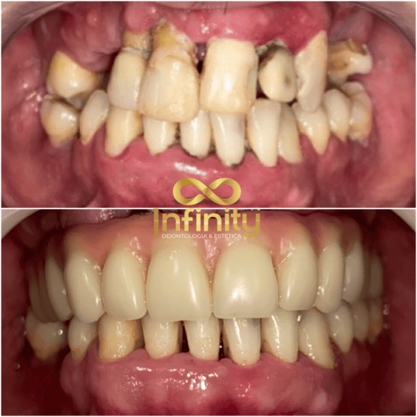 resultados tratamentos com impalntes dentários (7)