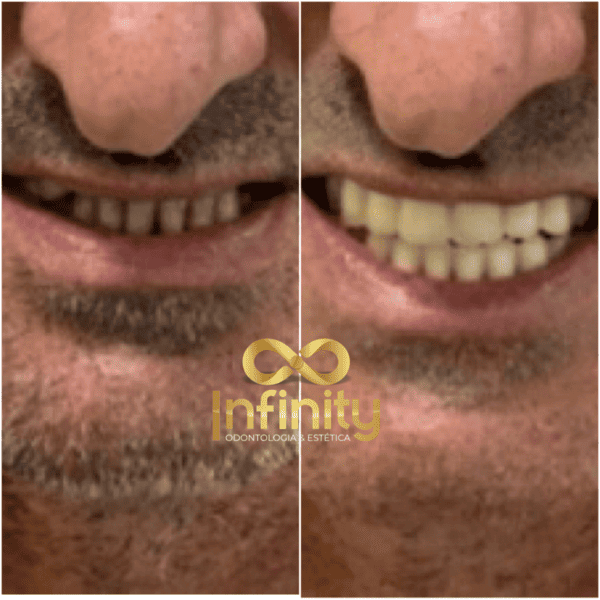 resultados tratamentos com impalntes dentários (8)